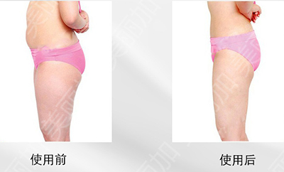 广州美丽加,5D精雕仪,面部美容,身体拨罐,除脂美体,减肥效果对比图