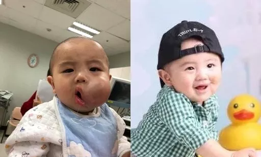 台湾医疗曹小弟弟左侧嘴角有一个小肿块