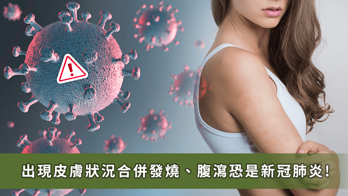 紅疹、水痘、瘀青都可能是新冠肺炎癥狀！合并發燒、腹瀉要馬上就醫