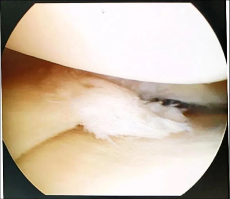 关节镜显示,半月板破裂处 关节镜显示,半月板破裂处