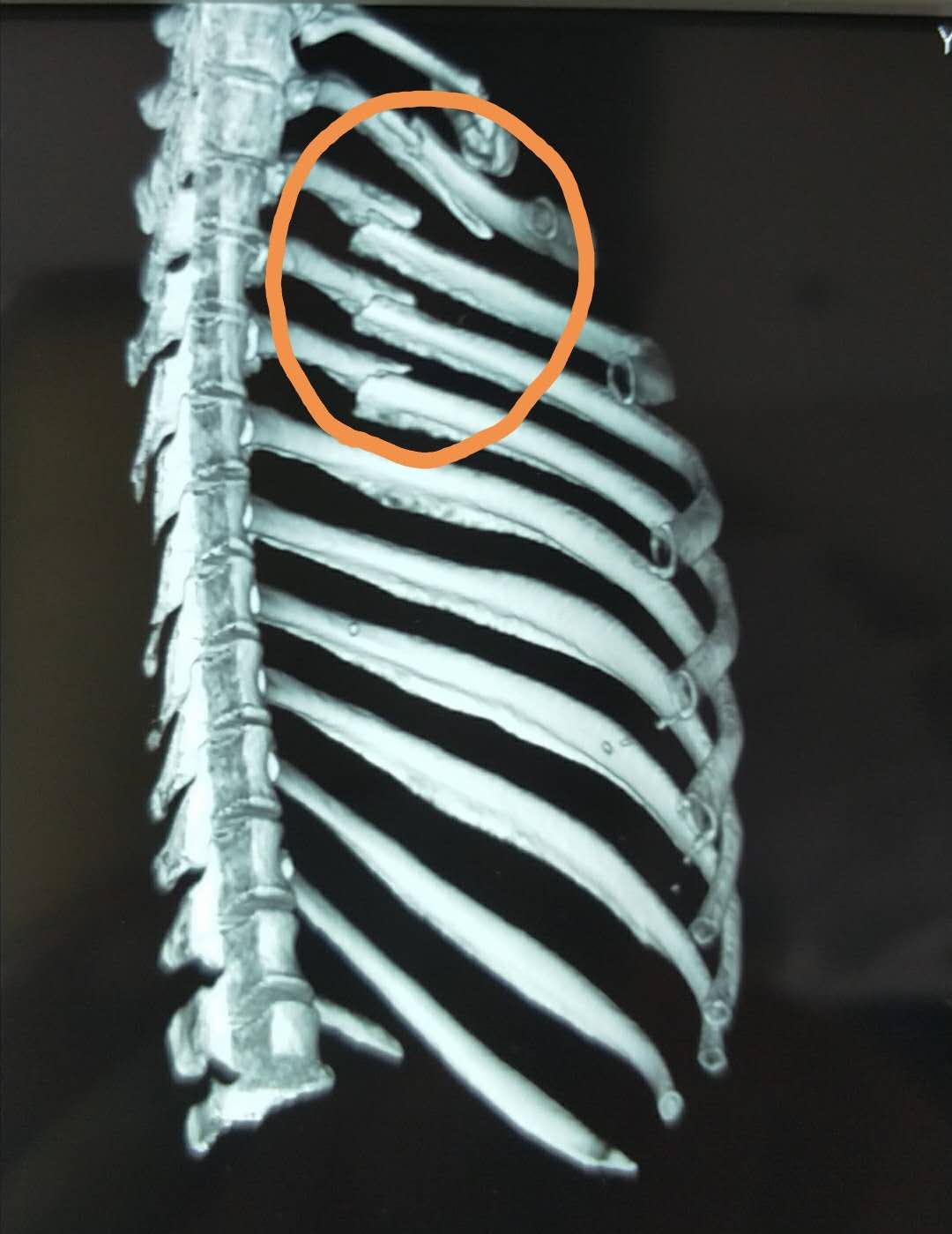 胸部ct显示右侧第1-5根肋骨骨折和左侧第8-9根肋骨骨折