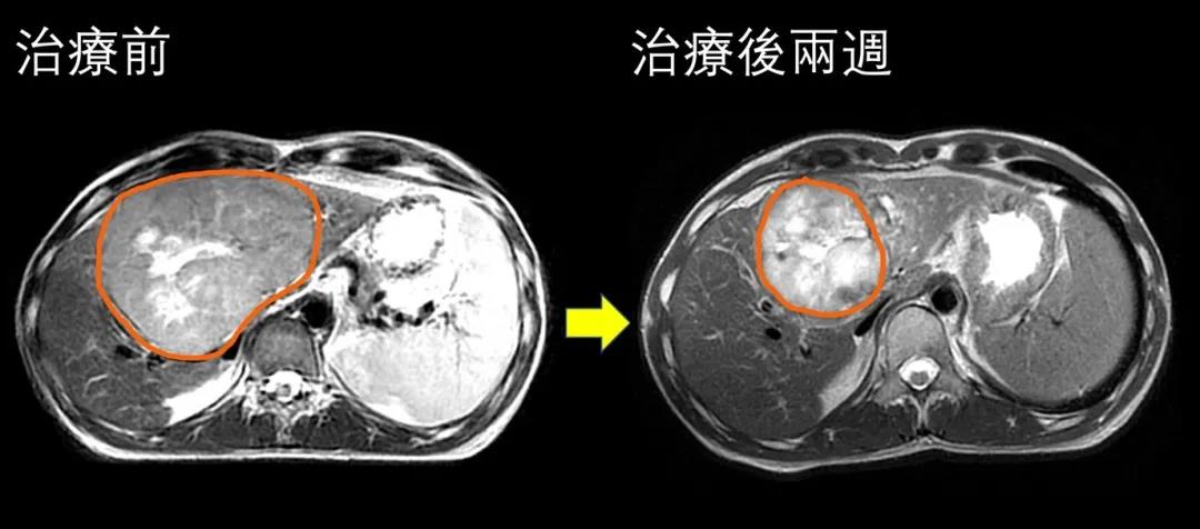 质子治疗后肿瘤(橙色线)明显缩小