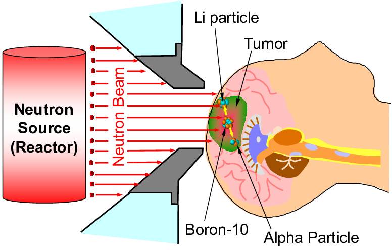 台湾硼中子捕获治疗