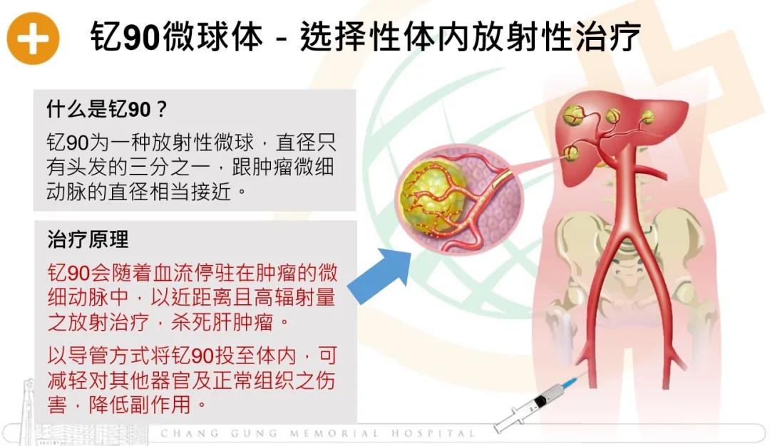 【台湾长庚医院】肝癌的动脉内治疗-钇90