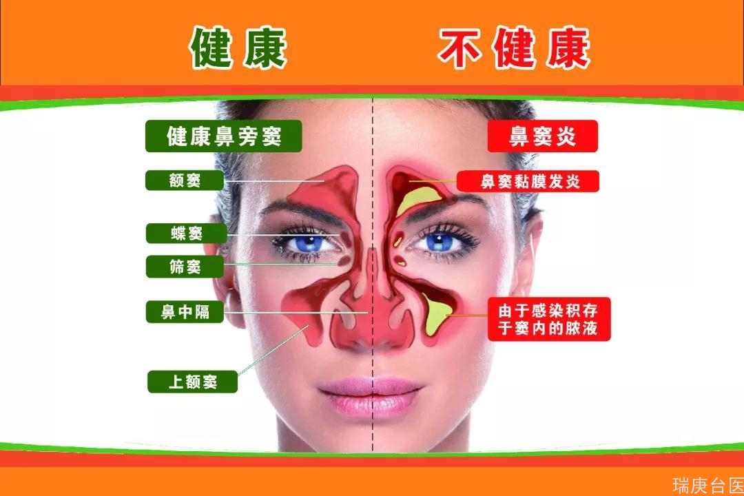 臺灣長庚醫院案例 | 鼻塞、流鼻水及頭痛，居然是鼻竇炎