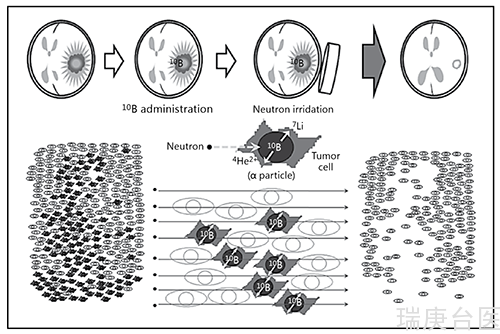 BNCT | 硼中子俘获疗法脊髓肿瘤放疗新选择