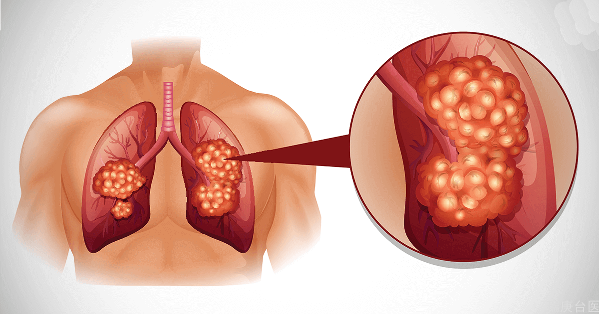 低剂量电脑断层揪肺肿瘤伪阳性高！专家建议：无创导航手术助诊断