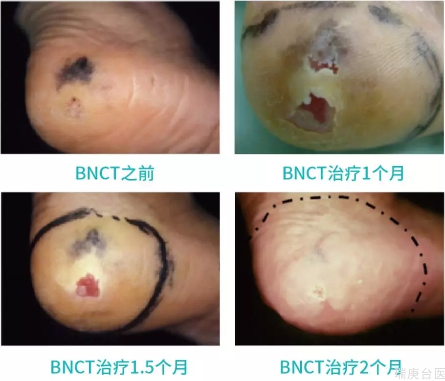 BNCT | 接受硼中子治疗的患者怎么样了？