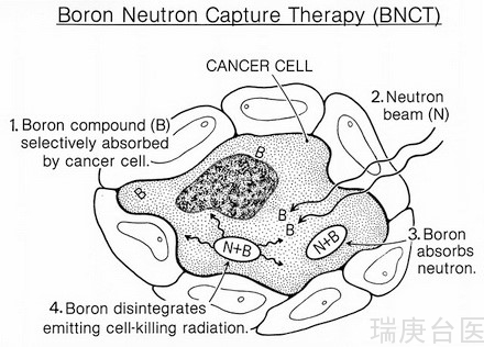 BNCT | 硼中子捕获治疗于台湾癌症放疗发展策略研究