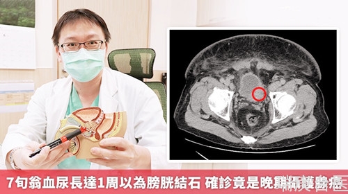 7旬翁血尿長達1周以為膀胱結石 確診竟是晚期攝護腺癌