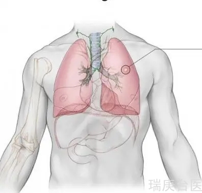 质子治疗肺癌 | 年长、肺功能不良者可考虑