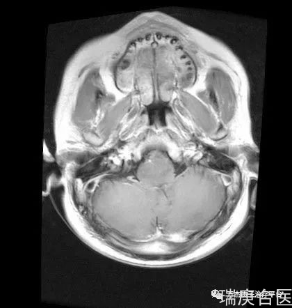 案例分享 | 质子治疗脑干胶质瘤的效果