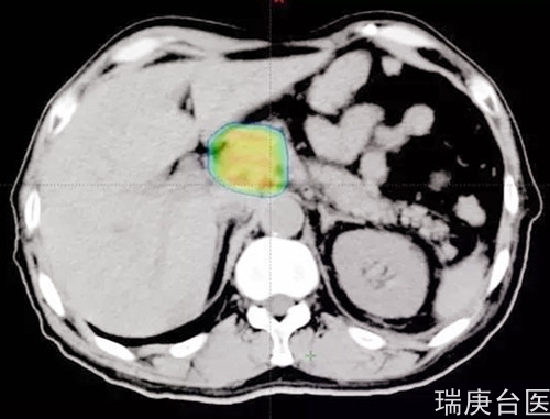 案例分享 | 食管癌腹膜后淋巴结转移 ,质子治疗肿瘤完全消失