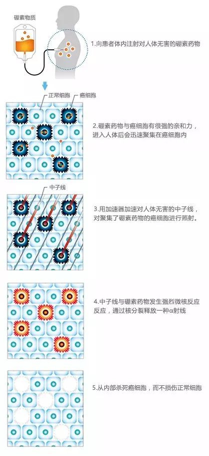 BNCT | 治疗复发性胶质母细胞瘤（GB)的新选择