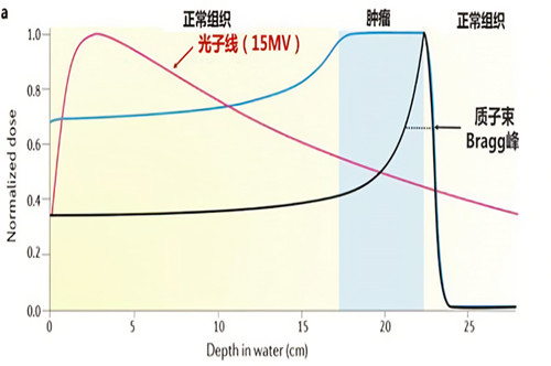 质子治疗案例 | 神经母细胞瘤、无副作用、无病